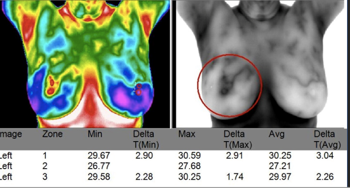Breast Thermography imaging
