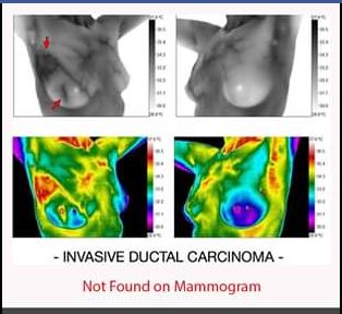 Mammogram vs thermography imaging
