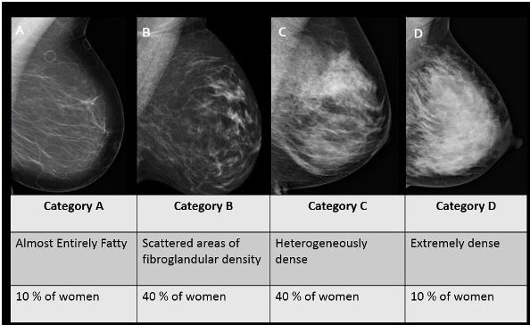The Connection Between Dense Breasts And Breast Cancer Patricia Bowden Luccardi