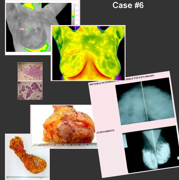 dense breast images