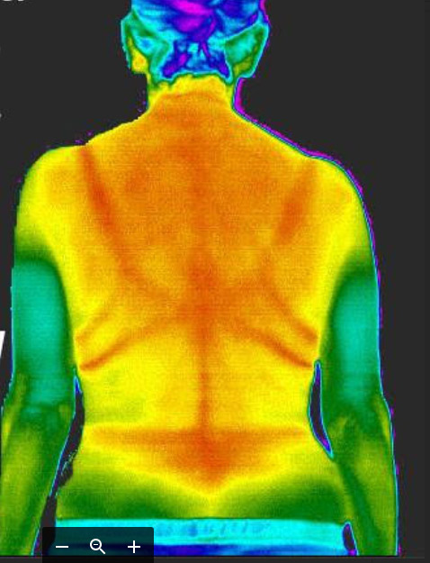 thermographic scan of woman with bra removed