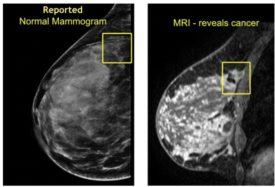 MRI reveals cancer