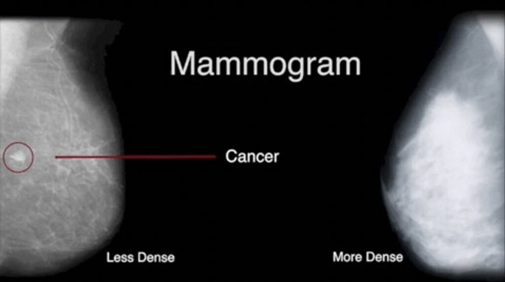 false negative mammogram