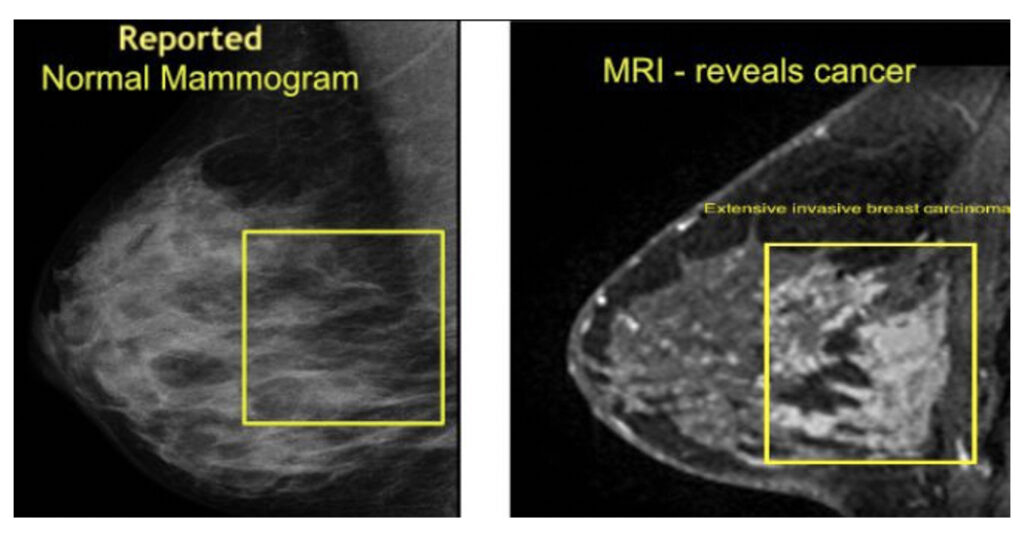 mammogram comparison