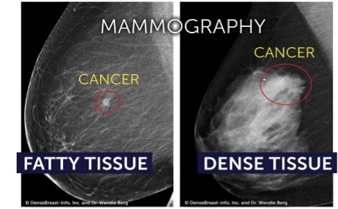 mammography for dense breasts